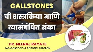 Gallstones ची शस्त्रक्रिया आणि त्या संबंधित शंका - डॉ. नीरज रायते