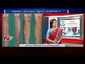 varicose veins symptoms causes u0026 treatments avis hospitals hello doctor ntv