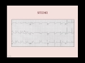 Acute Coronary Syndromes (old version, with sound) - CRASH! Medical Review Series