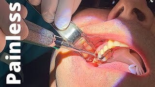 Tooth Extraction in Under 30 seconds - Pain Free Palatal Anesthesia