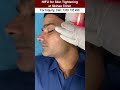 HIFU for Skin Tightening at Skinaa Clinic #hifu #hifutreatment #hifufacial #HIFU