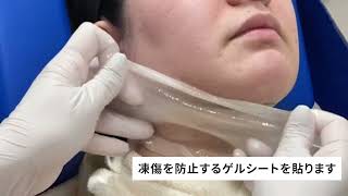 coolsculpting elite - 施術の流れ 【当山美容形成外科】