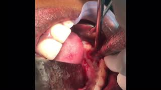 Dentigerous cyst - Impacted Supernumerary teeth removed