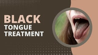 Black Tongue Treatment: 2 Effective Ways To Prevent It