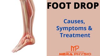 Foot Drop | Causes,  Symptoms, Diagnosis, Treatment \u0026 Exercises | In Hindi | Mera Physio