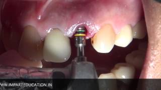 Immediate Implant Placement