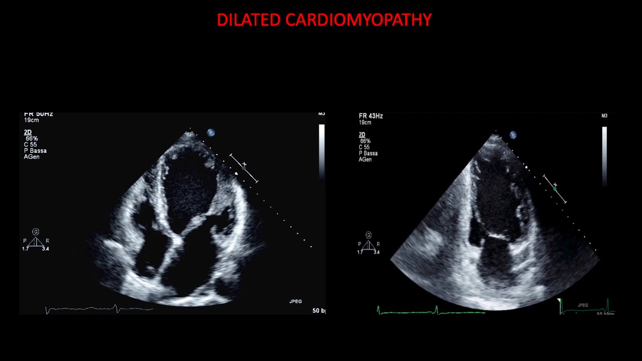 Echocardiography In Dilated Cardiomyopathy Youtube