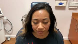 Dallas Botox for Cystic Acne Correction