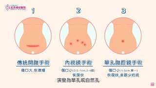 【婦科手術】宏其 3D/4K 微創手術中心_子宮肌瘤、卵巢腫瘤免擔心