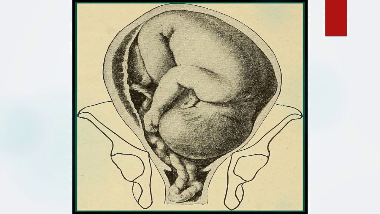 RCOG Guideline Umbilical Cord Prolapse No.50 - YouTube