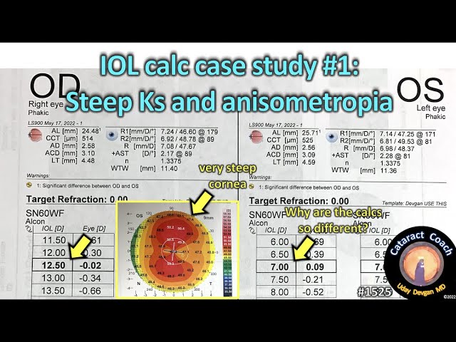 Iol Calculations In Ultra High Myopia â Cataract Coachâ 46 Off