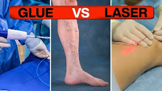 Ultimate Guide: VENASEAL vs Varicose Veins LASER!