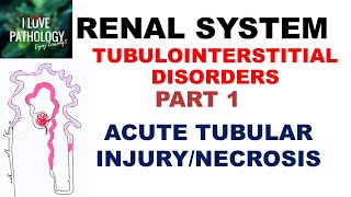 ACUTE TUBULAR INJURY/NECROSIS or ACUTE KIDNEY INJURY - Pathology
