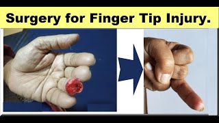 Finger Tip Injury.