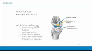 May 2020: Advanced Bracing Principles For Revision ACL and Complex Multi-Ligament Knee