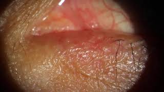 Expressing Pus from Puncta in Dacryocystitis