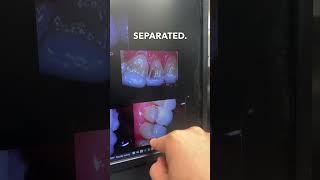 How Bad Veneers Look - A Visual Guide