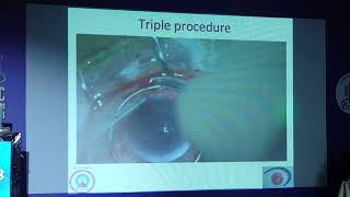 AIOC 2023 GP122 topic Dr Bhupesh Singh Challenges of Open Sky Cataract Surgery