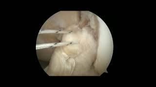 Arthroscopic Primary Repair of Proximal Anterior Cruciate Ligament Tears