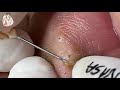 Relexing blackhead popping with Nasa Spa