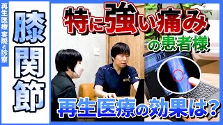 【変形性膝関節症】膝の痛みで睡眠不足という、つらい毎日に再生医療（幹細胞治療）が明かりを灯しました！治療直後より症状が改善