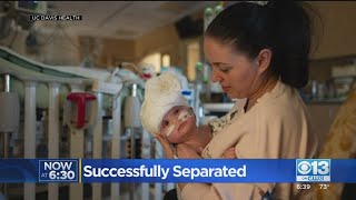 Conjoined Twins Successfully Separated At UC Davis Children’s Hospital