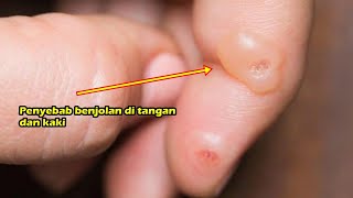 Kenali Berbagai Penyebab yang Menimbulkan Benjolan di Jari Tangan dan Kaki