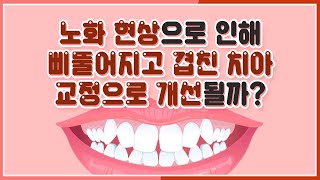 치아교정장치 노화로 틀어진 내 치아 개선 가능할까?!(Is it possible to improve my teeth that have been twisted by aging?!)