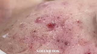 Popping Tons Of Blackheads Part 56