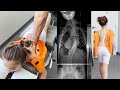 Scoliosis Treatment with Gonstead Chiropractic Care |Ep2| Dr. Rahim