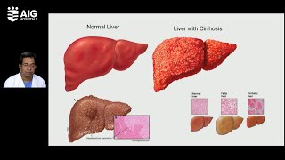 Liver Cirrhosis: Common Precautions | Dr. Mithun Sharma | AIG Hospitals