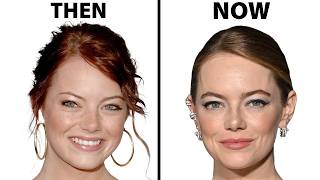 Emma Stone's NEW FACE | Plastic Surgery Analysis