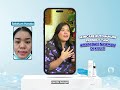 Wajah Hancur Parah Karena Skincare Merkuri Bisa Sembuh Pakai Haruka - Lia - Review Haruka Skincare