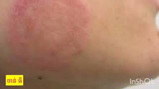 រោគសញ្ញាជំងឺស្រែង: Symptoms of ringworm