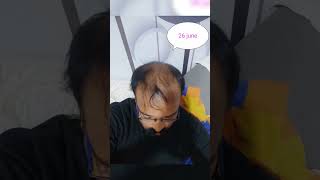 hair regrowth 4 months result without hair transplant