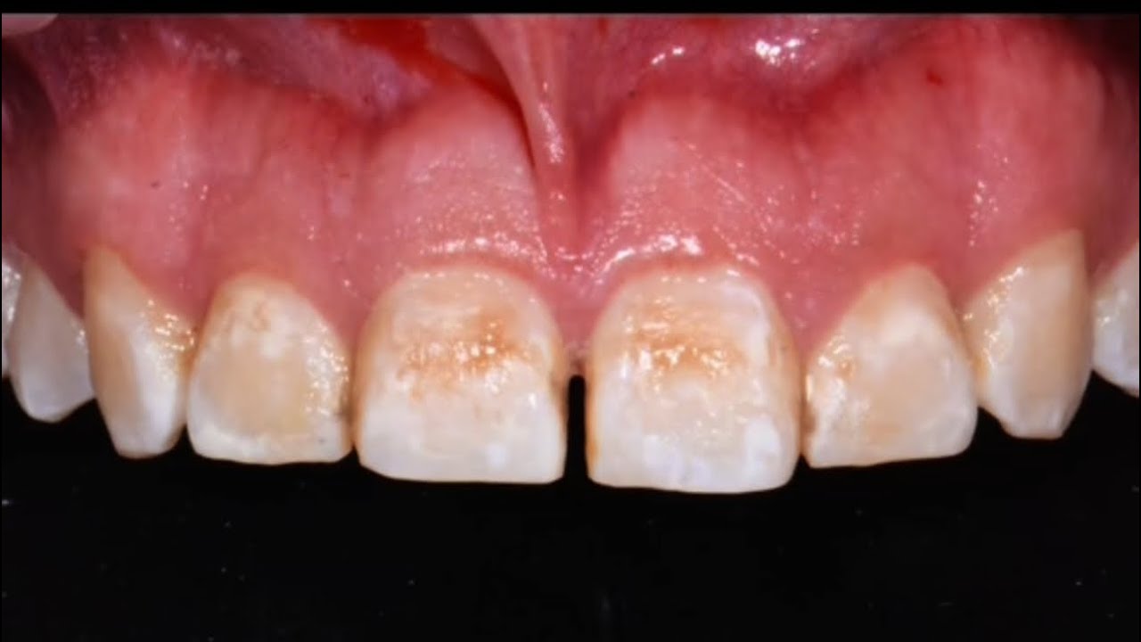 Teeth Sandblasting Youtube