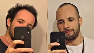 BALDING HAIR vs BUZZ CUT At 23 - My Experience