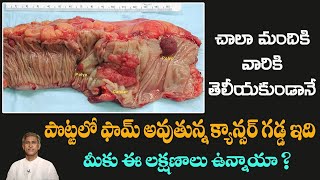 How to Avoid Colon Cancer | Reduces Constipation | Get Free Motion | Dr. Manthena's Health Tips