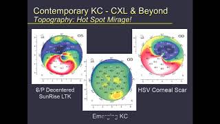 Contemporary Keratoconus Treatment Strategies - Dr. Clark Chang