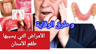 هل طقم الأسنان يسبب الأمراض الخطيرة ؟ 😩و ما هي طرق الوقاية.تركيبات الأسنان المتحركة الكاملةوالجزئية