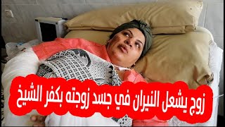 ملقيش فلوس في حسابها فاشترى بنزين.. زوج يشعل النيران في جسد زوجته بكفر الشيخ