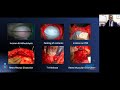 Posterior Component Separation Technique for Loss of Domain - Dr. Ramesh Punjani #LOD2021 #AWRSC