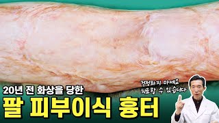 이런 화상흉터가 있다면 저한테 오세요! 제가 치료해드리겠습니다! ［미소사랑의원］