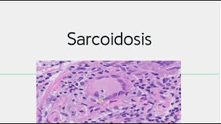 Sarcoidosis : Morphology, Pathogenesis