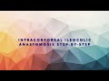 Intracorporeal ileocolic anastomosis step-by-step