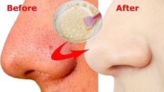 5 मिनट में ब्लैकहेड्स और वाइटहेड्स को खत्म करने का उपाए\\ Get rid of black \u0026 white heads in 5 Minute