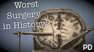 The Dark side of Science: The Lobotomy, the worst surgery in history? (Documenta