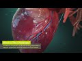 techinIQ Rotate or Retract by Corindus (3D Medical animation 2022)