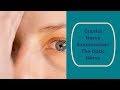 Cranial Nerve Examination: CN 2 Optic nerve