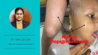 Nevus Depigmentosus | White birth mark and its treatment? Skin me safed dag ka karan aur ilaz?